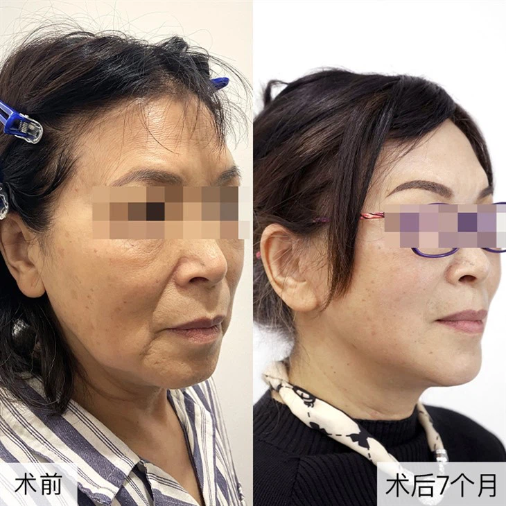 4Sagging Chin Repair