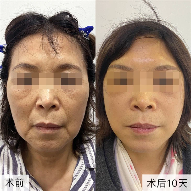 2Improvement of sagging chin