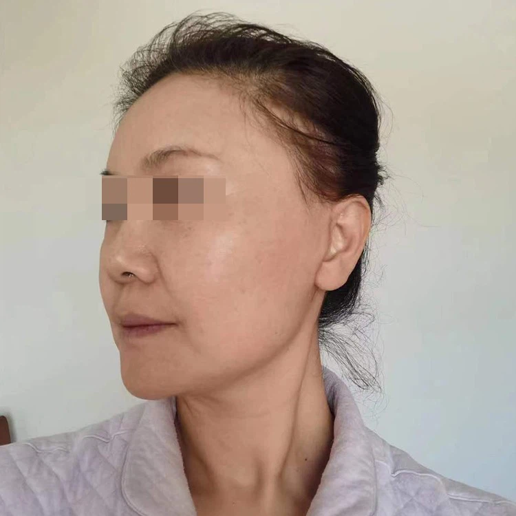 Nasolabial fold filler recovery period